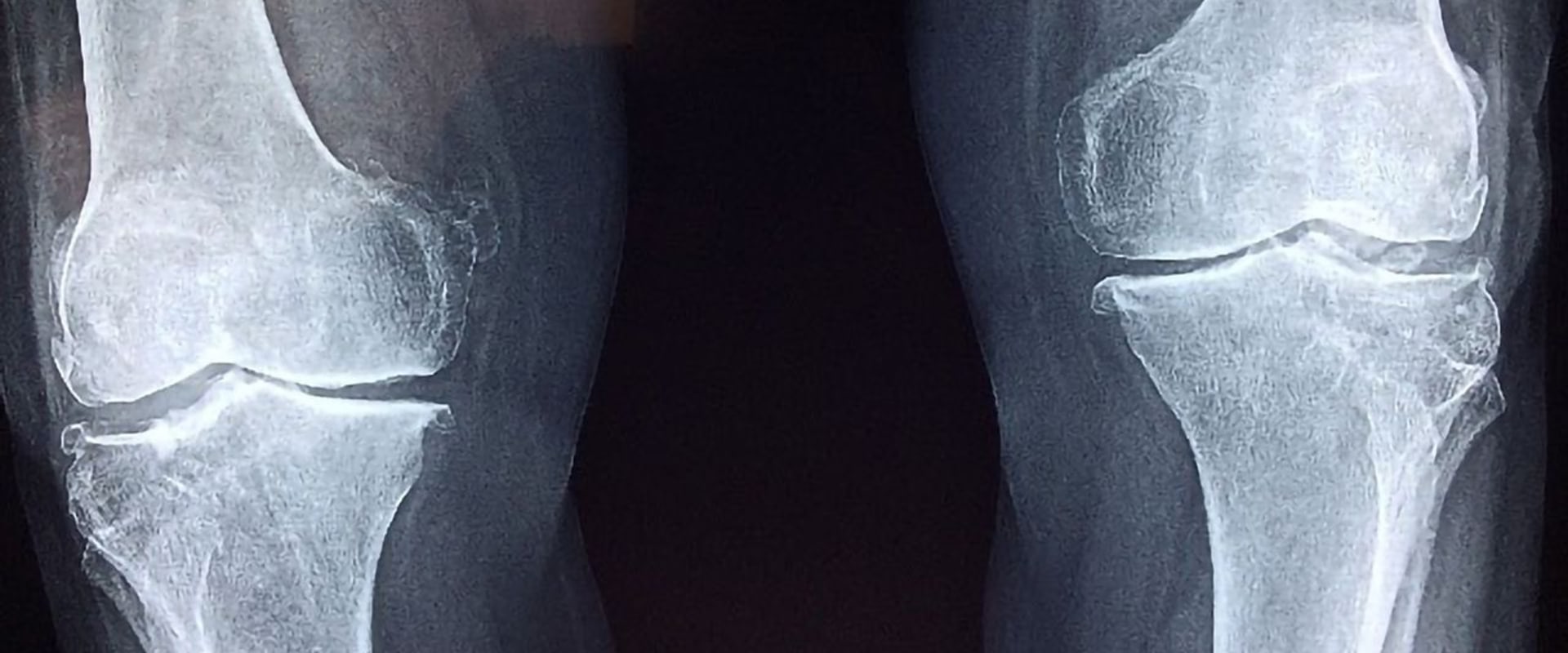 Can stem cells regrow knee cartilage?